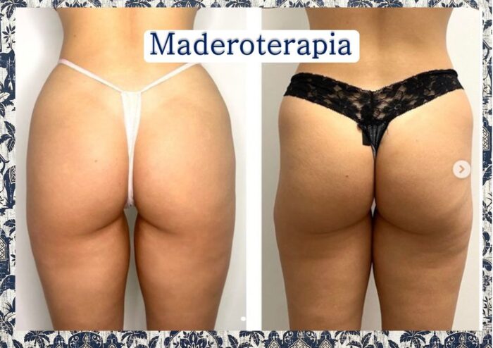 Maderoterapia 20 sesiones - Imagen 3